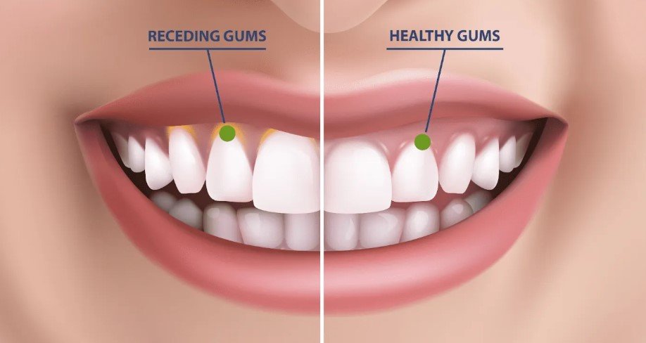 Oil Pulling for Receding Gums: Before and After Results