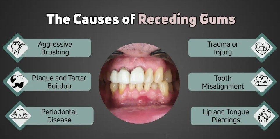 Causes Of Receding Gums