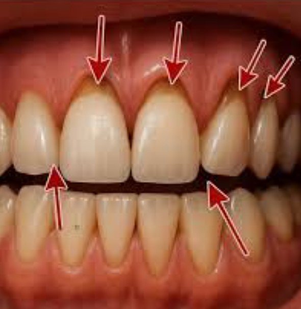 At Home test for gum recession